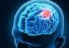 Biomarkers Could Help Predict Recurrence of Malignant Brain Tumor Biomarkers Could Help Predict Recurrence of Malignant Brain Tumor