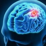 Biomarkers Could Help Predict Recurrence of Malignant Brain Tumor