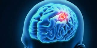 Biomarkers Could Help Predict Recurrence of Malignant Brain Tumor