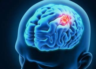 Biomarkers Could Help Predict Recurrence of Malignant Brain Tumor