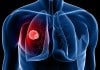New Study validates Liquid Biopsy for Lung Cancer