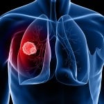 New Study validates Liquid Biopsy for Lung Cancer