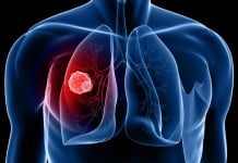 New Study validates Liquid Biopsy for Lung Cancer