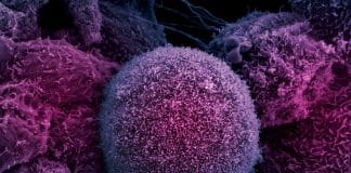 Deep Buried Link between Extrachromosomal DNA and Tumors Unearthed