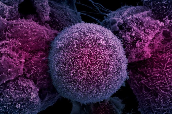 Deep Buried Link between Extrachromosomal DNA and Tumors Unearthed