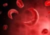 CRISPRs Point Way to New Sickle Cell Disease Therapies