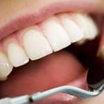 Happy Teeth: Researchers find that use of nanoparticles can prevent tooth decay
