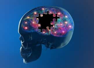 NLRP3-Associated Pathways a Novel Therapeutic Target for Alzheimer’s