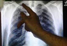 Is Tuberculosis An Autoimmune Disease?