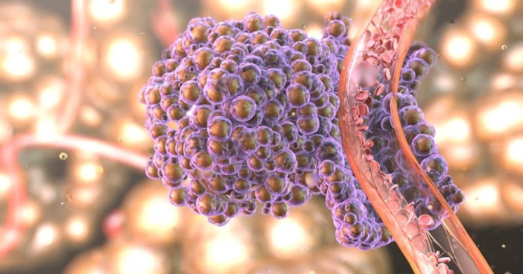 Analysis of Pixelated Spatial Gene Expression - Rapid Cancer Recognition
