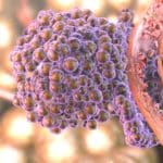 Analysis of Pixelated Spatial Gene Expression - Rapid Cancer Recognition