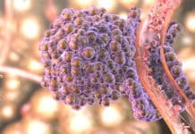 Analysis of Pixelated Spatial Gene Expression Allows for Rapid Cancer Identification Analysis of Pixelated Spatial Gene Expression - Rapid Cancer Recognition