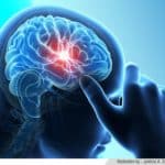 Stem-Cell-based Stroke Treatment Found to Reduce Brain Damage