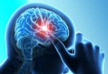 IBM’s Watson Comes To Aid : To Help Tackle Brain Tumour Stem-Cell-based Stroke Treatment Found to Reduce Brain Damage