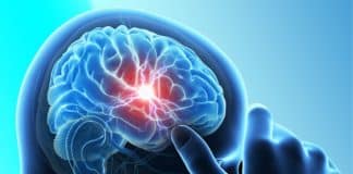 Stem-Cell-based Stroke Treatment Found to Reduce Brain Damage