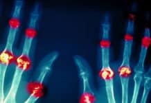 FDA Panel Turns Down J&J Arthritis Candidate, Cites Patient Death As Reason