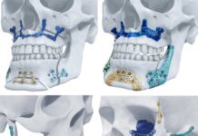 J&J’s DePuy Synthes Gets A Go-Ahead For Its 3D-Printed Titanium