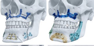 J&J’s DePuy Synthes Gets A Go-Ahead For Its 3D-Printed Titanium