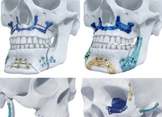 J&J’s DePuy Synthes Gets A Go-Ahead For Its 3D-Printed Titanium