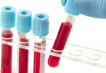 Pain Therapeutics Swoops Up $4 Million For Alzheimer’s Blood Test And Fentanyl-Based Patch Pain Therapeutics Swoops Up $4 Million For Alzheimer's Blood Test