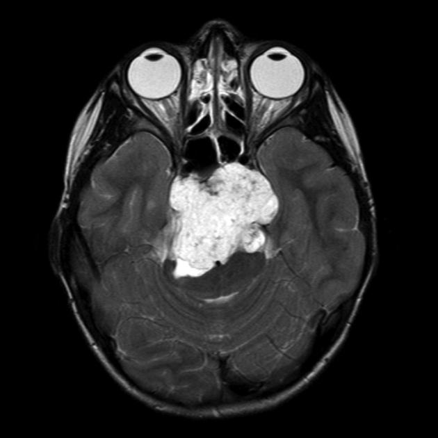 Rare Bone Cancer Could be Remedied with Existing Drug