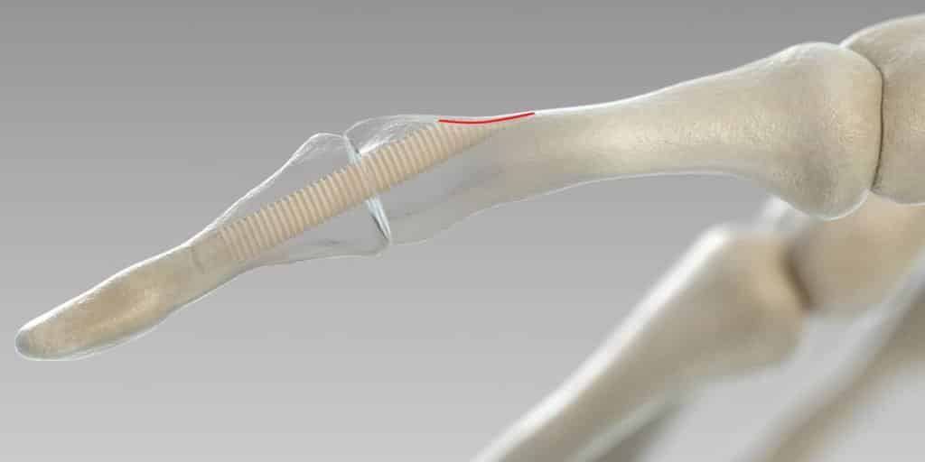 Mending Broken Bone Using Human Bone As Surgical Screws