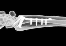 Mending A Broken Bone Using Anothers’ Bone? This Approach Uses Human Bone As Surgical Screws