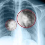 Astrazeneca’s Lung Cancer Drug Granted Breakthrough Therapy Designation In First-Line NSCLC