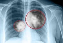 Astrazeneca’s Lung Cancer Drug Granted Breakthrough Therapy Designation In First-Line NSCLC Astrazeneca’s Lung Cancer Drug Granted Breakthrough Therapy Designation In First-Line NSCLC