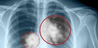 Astrazeneca’s Lung Cancer Drug Granted Breakthrough Therapy Designation In First-Line NSCLC
