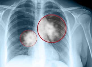 Astrazeneca’s Lung Cancer Drug Granted Breakthrough Therapy Designation In First-Line NSCLC