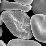 AI-Aided Microscope Boosts Malaria Diagnosis