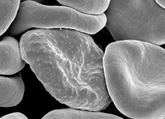 AI-Aided Microscope Boosts Malaria Diagnosis- Latest News AI-Aided Microscope Boosts Malaria Diagnosis