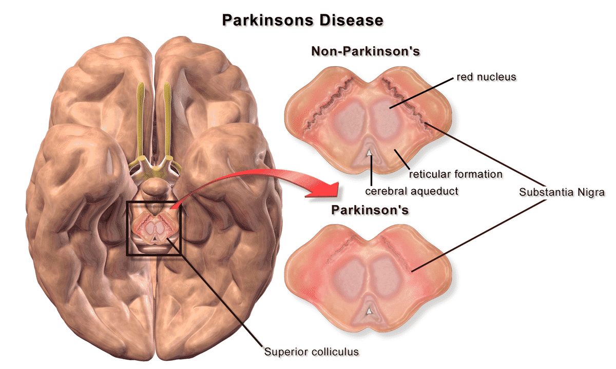 A Forthcoming Pandemic: Parkinson’s Disease