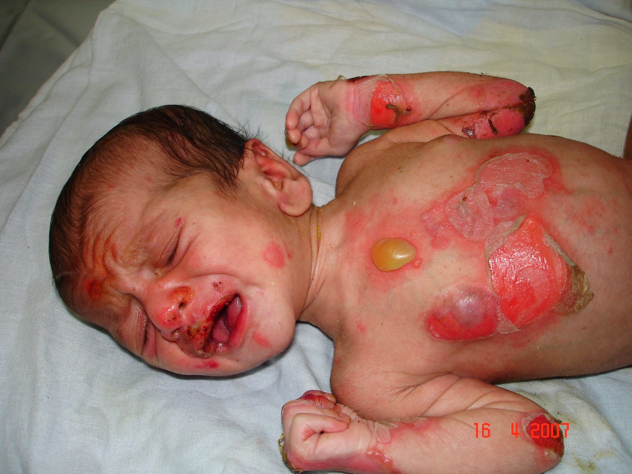 In A First, Scientists Give Boy Suffering From JEB Entirely New Skin Using Gene Therapy