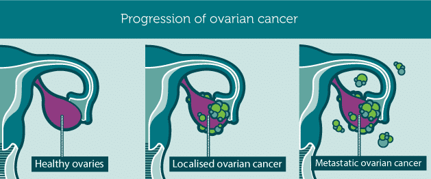 Researchers Use AI Diagnosis to Detect Ovarian Cancer Early and Accurately