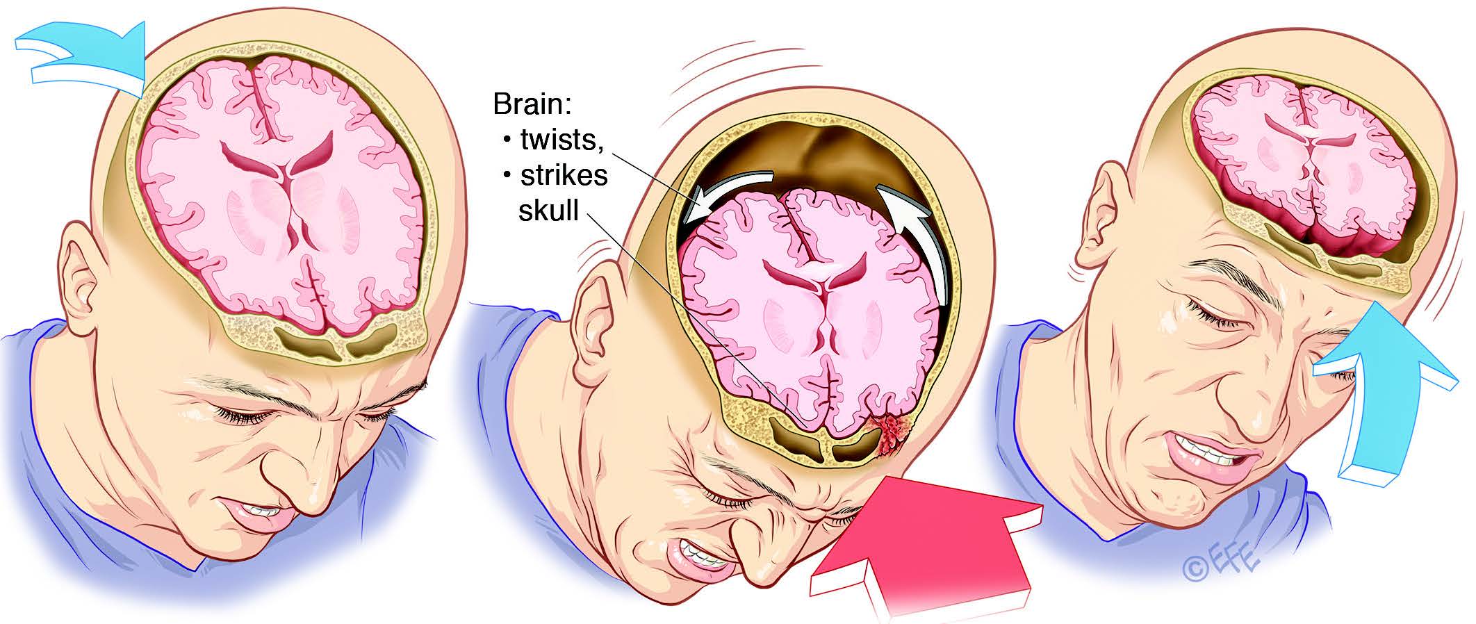 A Simple Spit Test for Better  Predictability of Duration of Concussions