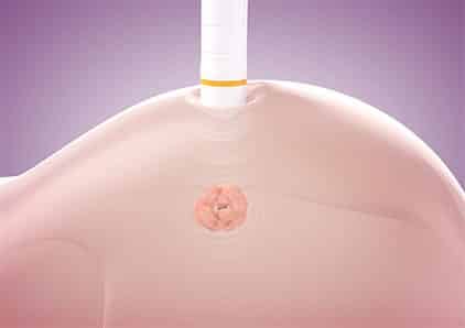 Cianna Medical’s Savi Scout Tumor Locator Approved by the FDA