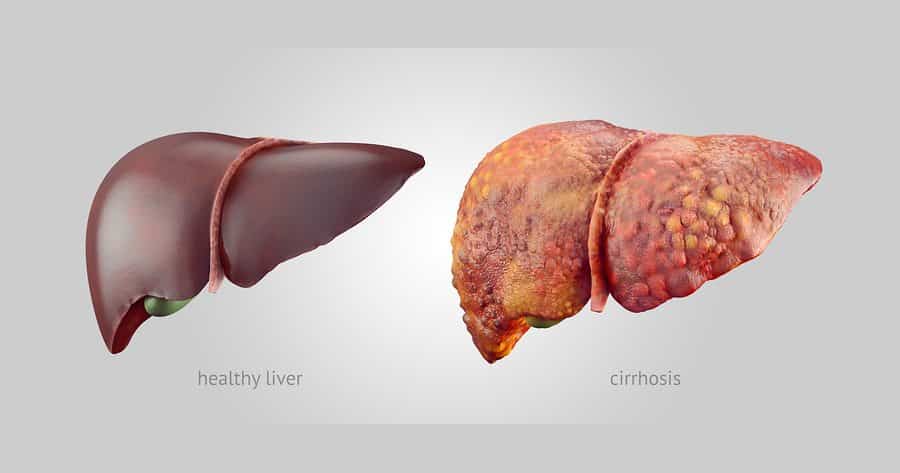 IBM Taps Machine Learning to Access Cirrhosis Mortality Rates