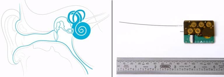 Novel Drug Delivery Device for Inner Ear Disorders Developed