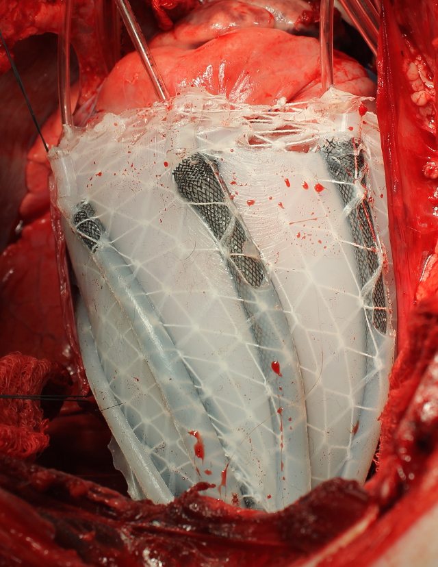 Soft Robot Encases Flabby Heart, Helping it Better Pump Blood