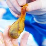 German Pharmacist Finds Protein That Drives Gallbladder Cancer