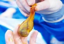 German Pharmacist Finds Protein That Drives Gallbladder Cancer German Pharmacist Finds Protein That Drives Gallbladder Cancer