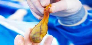 German Pharmacist Finds Protein That Drives Gallbladder Cancer