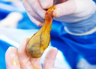 German Pharmacist Finds Protein That Drives Gallbladder Cancer