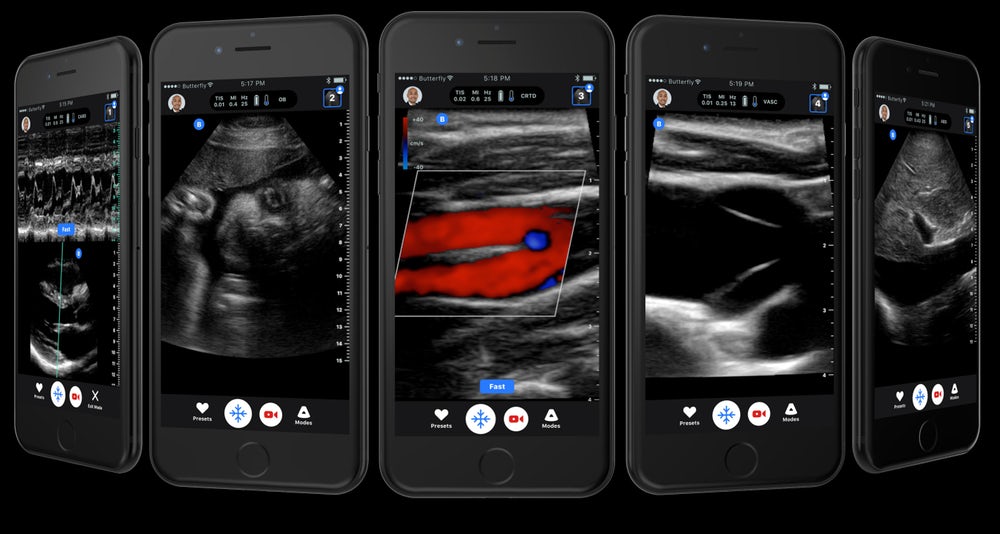 Smartphone-Connected Ultrasound-On-a-Chip Greenlit by FDA