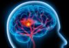New Guidelines Dictate Better Stroke Strategies
