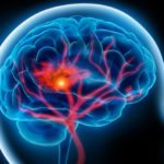 New Guidelines Dictate Better Stroke Strategies