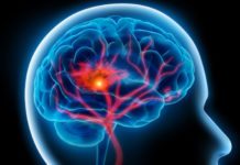 New Guidelines Dictate Better Stroke Strategies