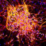 Protein Mutations Associated with Alzheimer’s Linked to Cancer Risk